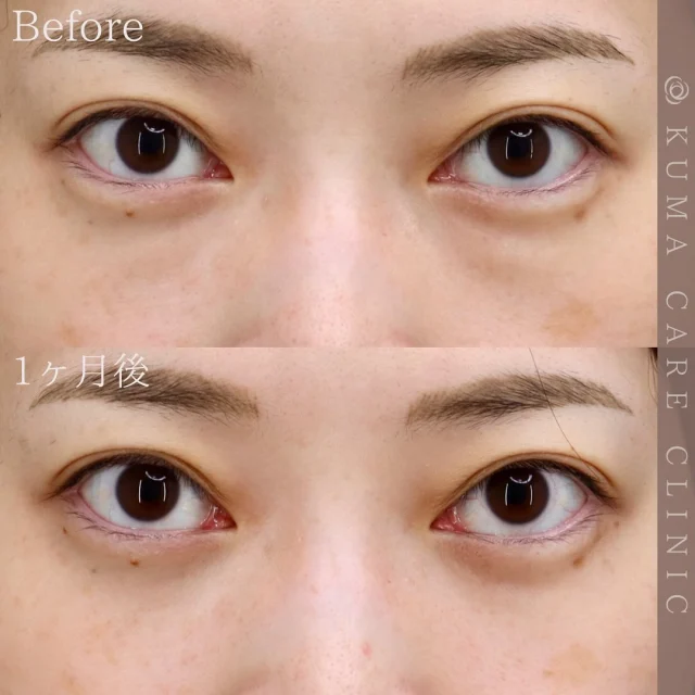 🌿

30代前半 女性の症例写真です📷
術前・術直後・一ヶ月後のノーメイクでの比較写真です。
⚠️実際の脂肪を載せているため、苦手な方はご注意下さい。

「15年程前から気になっていたクマが綺麗になくなって嬉しいです。涙袋も前より強調されて目元がより可愛くなった気がします。術後は、目を閉じると軽い痛みが一週間ほどありましたが、内出血やむくみなどはなかったです。」とのお声を頂戴しました✨

カウンセリング・手術のご予約は、Web予約またはお電話にて承っております。カウンセリングは無料となります🌱
手術をご検討中の方は、是非ご相談にお越しくださいませ。
皆様のご来院をスタッフ一同、心よりお待ちしております🕊️

_________________________

■施術名  下眼瞼経結膜脱脂術
■価格  250,000円（税抜価格227,273円）　
■リスク
◉内出血・むくみ
　出来る限り丁寧に処置していますが、
　術後1〜2週間程度は生じる可能性があります。
◉術後出血
　治癒過程により、術後1週間以内は
　血液混じりの涙が出る可能性があります。
◉結膜浮腫・結膜出血
　かなり稀ですが生じる可能性があります。
　一般的には術後1～2週間で軽快します。

_________________________

KUMA CARE CLINIC 大阪院
📍大阪市北区鶴野町2-1タナダビル5F
☎️06-6136-3537
⏰10:00〜19:00

#KUMACARECLINIC #クマケアクリニック
#クマ治療 #クマケア #クマ取り #脱脂術
#クマ取り脱脂術 #目の下のたるみ取り
#目の下のクマ取り #目の下のクマたるみ取り
#目の下の若返り #アンチエイジング
#くま #クマ #下眼瞼脱脂術 #たるみ
#大阪 #梅田 #茶屋町 #クマ治療大阪
#美容外科 #美容外科大阪 #クマ取り専門
#美容整形 #美容クリニック