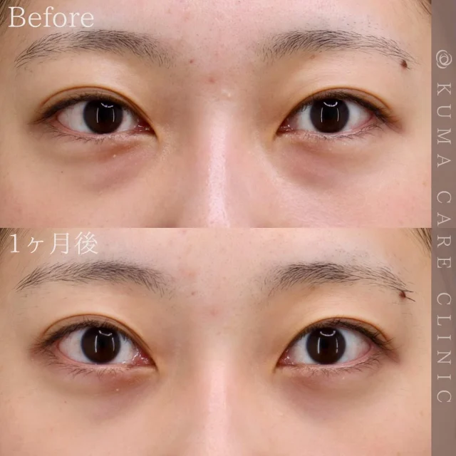 🌿

20代後半　女性の症例写真です📷
術前・術直後・一ヶ月後のノーメイクでの比較写真です。
※色味の強い方の症例となります。
⚠️実際の脂肪を載せているため、苦手な方はご注意下さい。

「術後はむくみが3日間ほどあり、目の下が突っ張っているような感覚は感じましたが内出血は無かったので良かったです。気になっていたクマがなくなったので、手術を受けて良かったです。」とのお声を頂戴しました✨

カウンセリング・手術のご予約は、Web予約またはお電話にて承っております。カウンセリングは無料となります🌱
手術をご検討中の方は、是非ご相談にお越しくださいませ。
皆様のご来院をスタッフ一同、心よりお待ちしております🕊️

_________________________

■施術名  下眼瞼経結膜脱脂術
■価格  250,000円（税抜価格227,273円）　
■リスク
◉内出血・むくみ
　出来る限り丁寧に処置していますが、
　術後1〜2週間程度は生じる可能性があります。
◉術後出血
　治癒過程により、術後1週間以内は
　血液混じりの涙が出る可能性があります。
◉結膜浮腫・結膜出血
　かなり稀ですが生じる可能性があります。
　一般的には術後1～2週間で軽快します。

_________________________

KUMA CARE CLINIC 大阪院
📍大阪市北区鶴野町2-1タナダビル5F
☎️06-6136-3537
⏰10:00〜19:00

#KUMACARECLINIC #クマケアクリニック
#クマ治療 #クマケア #クマ取り #脱脂術
#クマ取り脱脂術 #目の下のたるみ取り
#目の下のクマ取り #目の下のクマたるみ取り
#目の下の若返り #アンチエイジング
#くま #クマ #下眼瞼脱脂術 #たるみ
#大阪 #梅田 #茶屋町 #クマ治療大阪
#美容外科 #美容外科大阪 #クマ取り専門
#美容整形 #美容クリニック