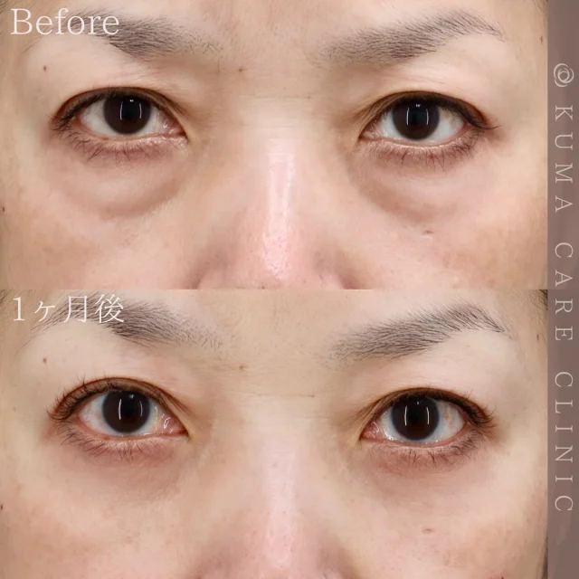 🌿

50代後半　女性の症例写真です📷
術前・術直後・一ヶ月後のノーメイクでの比較写真です。
※色味の強い方の症例となります。
⚠️実際の脂肪を載せているため、苦手な方はご注意下さい。

「術後は内出血などダウンタイムはなかったです。手術して大満足です。」との嬉しいお声を頂戴しました✨

カウンセリング・手術のご予約は、Web予約またはお電話にて承っております。カウンセリングは無料となります🌱
手術をご検討中の方は、是非ご相談にお越しくださいませ。
皆様のご来院をスタッフ一同、心よりお待ちしております🕊️

_________________________

■施術名  下眼瞼経結膜脱脂術
■価格  250,000円（税抜価格227,273円）　
■リスク
◉内出血・むくみ
　出来る限り丁寧に処置していますが、
　術後1〜2週間程度は生じる可能性があります。
◉術後出血
　治癒過程により、術後1週間以内は
　血液混じりの涙が出る可能性があります。
◉結膜浮腫・結膜出血
　かなり稀ですが生じる可能性があります。
　一般的には術後1～2週間で軽快します。

_________________________

KUMA CARE CLINIC 大阪院
📍大阪市北区鶴野町2-1タナダビル5F
☎️06-6136-3537
⏰10:00〜19:00

#KUMACARECLINIC #クマケアクリニック
#クマ治療 #クマケア #クマ取り #脱脂術
#クマ取り脱脂術 #目の下のたるみ取り
#目の下のクマ取り #目の下のクマたるみ取り
#目の下の若返り #アンチエイジング
#くま #クマ #下眼瞼脱脂術 #たるみ
#大阪 #梅田 #茶屋町 #クマ治療大阪
#美容外科 #美容外科大阪 #クマ取り専門
#美容整形 #美容クリニック