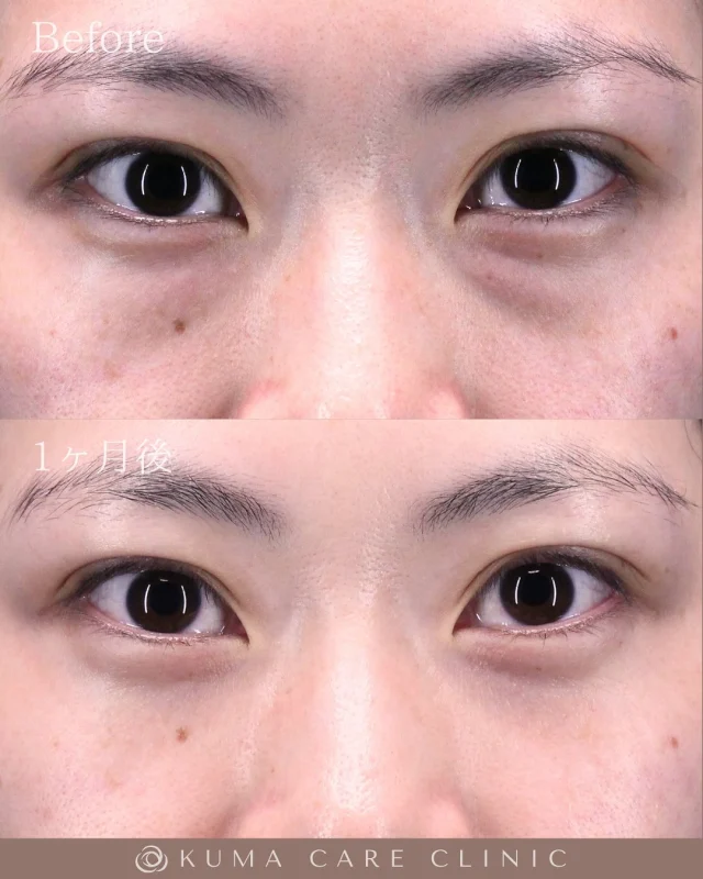 🌱
🌱20代後半の女性のくまとり解説🌱 

術前・術直後・一ヶ月後のノーメイクでの比較写真です。 
⚠️実際の脂肪を載せているため、苦手な方はご注意下さい。 

こんにちは。 
クマケアクリニック名古屋院 
院長宮西重史です。 

今回は20代後半の女性のクマ取りをさせていただきました。 
この方は膨らみによる影ぐま（黒ぐま）がありました。 
今回脱脂のみで膨らみによる影が減り綺麗になられた患者様だと思います。 

10代の頃より黒ぐまが気になっていた患者様でです。術後はスッキリとした綺麗な目元になったと思います。仕上がりに関してもご満足いただけたようで、大変光栄です。 

ご本人様からも「目の腫れなど術後にどのよな感じになるかなどカウセリング時に詳しく説明をしていただけたので不安になることもなくダウンタイムを過ごせました。仕上がりも長い間気にしていたクマの膨らみが消えとても満足しています。ありがとうございました。」とのコメントをいただきました。 

この度はクマケアクリニック名古屋院を選んでいただき
誠にありがとうございました。

_________________________

■施術名 下眼瞼経結膜脱脂術
■価格　 250,000円（税抜価格 227,273円）
■リスク
◉内出血・むくみ
　出来る限り丁寧に処置していますが、
　術後1〜2週間程度は生じる可能性があります。
◉術後出血
　治癒過程により、術後1週間以内は
　血液混じりの涙が出る可能性があります。
◉結膜浮腫・結膜出血
　かなり稀ですが生じる可能性があります。
　一般的には術後1～2週間で軽快します。

_________________________

KUMA CARE CLINIC 名古屋院
📍名古屋市西区名駅3-10-15 名駅三丁目ビル2階
☎️052-564-7070
⏰9:00〜18:00
_________________________

#KUMACARECLINIC名古屋 #クマケアクリニック名古屋
#クマ治療 #クマケア #クマ取り #脱脂術
#クマ取り脱脂術 #目の下のたるみ取り
#目の下のクマ取り #目の下のクマたるみ取り
#目の下の若返り #アンチエイジング
#くま #クマ #下眼瞼脱脂術 #たるみ
#愛知 #名古屋 #名駅 #クマ治療名古屋
#美容外科 #美容外科名古屋 #クマ取り専門　
#美容整形 #美容クリニック