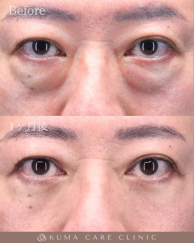 🌱
🌱40代後半の男性のくまとり解説🌱 

術前・術直後・一ヶ月後のノーメイクでの比較写真です。 
⚠️実際の脂肪を載せているため、苦手な方はご注意下さい。 

こんにちは。 
クマケアクリニック名古屋院 
院長宮西重史です。 

今回は40代後半の男性のクマ取りをさせていただきました。 
この方は膨らみによる影ぐま（黒ぐま）とがあり、かなり膨らみが強いので、
カウンセリングにて事前にメリットやデメリットを説明の上、
患者様のご希望のうえで施術を行わせたいただきました。 

どうしても皮膚のタルミによる小じわはありますが、
大きな膨らみがなくなる事でスッキリとした目元になりました。 
仕上がりに関してもご満足いただけたようで、大変光栄です。 

ご本人様からも「私の場合は他の方よりも目尻側にも脂肪があり通常の施術と比較すると大変との説明を受けましたが、綺麗に丁寧に施術していただけました。痛みに弱い方は笑気麻酔の追加をオススメします」とコメントをいただきました。 

この度はクマケアクリニック名古屋院を選んでいただき
誠にありがとうございました。

_________________________

■施術名 下眼瞼経結膜脱脂術
■価格　 250,000円（税抜価格 227,273円）
■リスク
◉内出血・むくみ
　出来る限り丁寧に処置していますが、
　術後1〜2週間程度は生じる可能性があります。
◉術後出血
　治癒過程により、術後1週間以内は
　血液混じりの涙が出る可能性があります。
◉結膜浮腫・結膜出血
　かなり稀ですが生じる可能性があります。
　一般的には術後1～2週間で軽快します。

_________________________

KUMA CARE CLINIC 名古屋院
📍名古屋市西区名駅3-10-15 名駅三丁目ビル2階
☎️052-564-7070
⏰9:00〜18:00
_________________________

#KUMACARECLINIC名古屋 #クマケアクリニック名古屋
#クマ治療 #クマケア #クマ取り #脱脂術
#クマ取り脱脂術 #目の下のたるみ取り
#目の下のクマ取り #目の下のクマたるみ取り
#目の下の若返り #アンチエイジング
#くま #クマ #下眼瞼脱脂術 #たるみ
#愛知 #名古屋 #名駅 #クマ治療名古屋
#美容外科 #美容外科名古屋 #クマ取り専門　
#美容整形 #美容クリニック