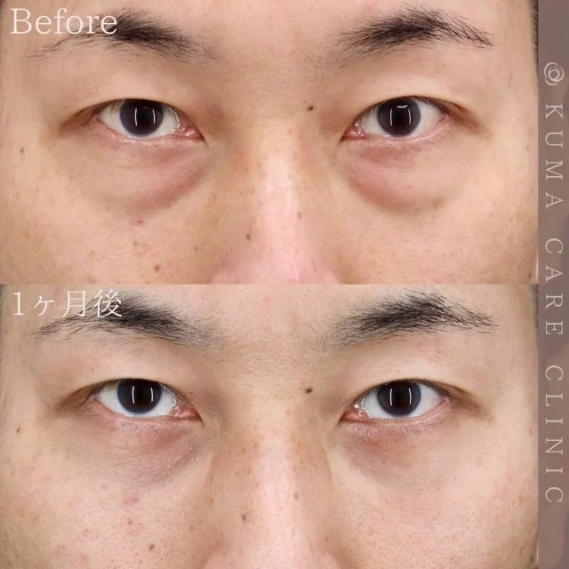 🌿

40代前半　男性の症例写真です📷
術前・術直後・一ヶ月後のノーメイクでの比較写真です。
⚠️実際の脂肪を載せているため、苦手な方はご注意下さい。

「術後は3日ほど内出血があり、少し霞む感じが一時的にありました。目の下の膨らみがなくなり大変満足しています。」との嬉しいお声を頂戴しました✨

カウンセリング・手術のご予約は、Web予約またはお電話にて承っております。カウンセリングは無料となります🌱
手術をご検討中の方は、是非ご相談にお越しくださいませ。
皆様のご来院をスタッフ一同、心よりお待ちしております🕊️

_________________________

■施術名  下眼瞼経結膜脱脂術
■価格  250,000円（税抜価格227,273円）　
■リスク
◉内出血・むくみ
　出来る限り丁寧に処置していますが、
　術後1〜2週間程度は生じる可能性があります。
◉術後出血
　治癒過程により、術後1週間以内は
　血液混じりの涙が出る可能性があります。
◉結膜浮腫・結膜出血
　かなり稀ですが生じる可能性があります。
　一般的には術後1～2週間で軽快します。

_________________________

KUMA CARE CLINIC 大阪院
📍大阪市北区鶴野町2-1タナダビル5F
☎️06-6136-3537
⏰10:00〜19:00

#KUMACARECLINIC #クマケアクリニック
#クマ治療 #クマケア #クマ取り #脱脂術
#クマ取り脱脂術 #目の下のたるみ取り
#目の下のクマ取り #目の下のクマたるみ取り
#目の下の若返り #アンチエイジング
#くま #クマ #下眼瞼脱脂術 #たるみ
#大阪 #梅田 #茶屋町 #クマ治療大阪
#美容外科 #美容外科大阪 #クマ取り専門
#美容整形 #美容クリニック