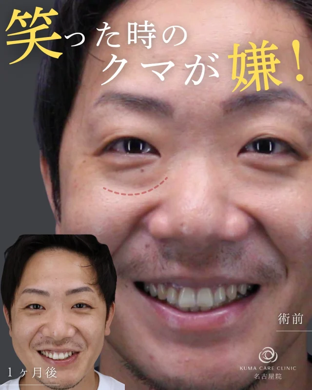 ☘️
🧑🏻‍💼「笑ったときにクマがずっと気になってて…」

そんなお悩みを持つ
美容クリニックが初めての
30代男性が、クマ取りを決意✨

「なんとなく老けて見える」
「元気なのに疲れて見える」
そんな印象、目元が原因かもしれません👀

目の下がスッキリするだけで、
表情も気持ちも前向きに変わります✨

📍クマケアクリニック名古屋院
院長・宮西が全例担当します✂️

_________________________

■施術名  下眼瞼経結膜脱脂術
■価格一律　  250,000円（税抜価格 227,273円）
■リスク
◉内出血・むくみ
　出来る限り丁寧に処置していますが、
　術後1〜2週間程度は生じる可能性があります。
◉術後出血
　治癒過程により、術後1週間以内は
　血液混じりの涙が出る可能性があります。
◉結膜浮腫・結膜出血
　かなり稀ですが生じる可能性があります。
　一般的には術後1～2週間で軽快します。

_________________________

KUMA CARE CLINIC 名古屋院
📍名古屋市西区名駅3-10-15 名駅三丁目ビル2階
☎️052-564-7070
⏰9:00〜18:00
_________________________

#KUMACARECLINIC名古屋 #クマケアクリニック名古屋
#クマ治療 #クマケア #クマ取り #脱脂術
#クマ取り脱脂術 #目の下のたるみ取り
#目の下のクマ取り #目の下のクマたるみ取り
#目の下の若返り #アンチエイジング
#くま #クマ #下眼瞼脱脂術 #たるみ
#愛知 #名古屋 #名駅 #クマ治療名古屋
#美容外科 #美容外科名古屋 #クマ取り専門　
#美容整形 #美容クリニック