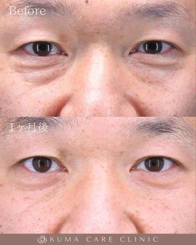 🌱
🌱50代前半の男性のくまとり解説🌱 

 術前・術直後・一ヶ月後のノーメイクでの比較写真です。 
⚠️実際の脂肪を載せているため、苦手な方はご注意下さい。 

こんにちは。 
クマケアクリニック名古屋院 
院長宮西重史です。 

今回は50代前半の男性のクマ取りをさせていただきました。 
この方は膨らみによる影ぐま（黒ぐま）があり、
今回脱脂術を行わせていただきました。
膨らみが無くなりスッキリとした目元になったと思います。 

ご家族に指摘されて膨らみを自覚したと仰っていた患者様でした。
ご紹介にて当院で施術させていただきました。 

仕上がりに関してもご満足いただけたようで、大変光栄です。 

ご本人様からも「緊張しましたが目元の膨らみが無くなって本当によかったです。」とのコメントをいただきました。 

この度はクマケアクリニック名古屋院を選んでいただき
誠にありがとうございました。

_________________________

■施術名 下眼瞼経結膜脱脂術
■価格　 250,000円（税抜価格 227,273円）
■リスク
◉内出血・むくみ
　出来る限り丁寧に処置していますが、
　術後1〜2週間程度は生じる可能性があります。
◉術後出血
　治癒過程により、術後1週間以内は
　血液混じりの涙が出る可能性があります。
◉結膜浮腫・結膜出血
　かなり稀ですが生じる可能性があります。
　一般的には術後1～2週間で軽快します。

_________________________

KUMA CARE CLINIC 名古屋院
📍名古屋市西区名駅3-10-15 名駅三丁目ビル2階
☎️052-564-7070
⏰9:00〜18:00
_________________________

#KUMACARECLINIC名古屋 #クマケアクリニック名古屋
#クマ治療 #クマケア #クマ取り #脱脂術
#クマ取り脱脂術 #目の下のたるみ取り
#目の下のクマ取り #目の下のクマたるみ取り
#目の下の若返り #アンチエイジング
#くま #クマ #下眼瞼脱脂術 #たるみ
#愛知 #名古屋 #名駅 #クマ治療名古屋
#美容外科 #美容外科名古屋 #クマ取り専門　
#美容整形 #美容クリニック