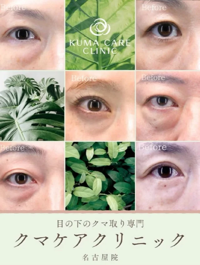 🌿
クマ取り脱脂術で自然な若返り✨
目元の印象が変わるだけで、表情や雰囲気までこんなに違います。
実際の患者様のビフォーアフターをご覧ください👀

🔹ダウンタイムが短い
🔹傷跡が残らない
🔹ナチュラルに若返り

「疲れて見える…」「化粧で隠せない…」
そんなお悩みがある方はぜひ参考にしてください。

_________________________ 
 
■施術名  下眼瞼経結膜脱脂術 
■価格　  250,000円（税抜価格 227,273円） 
■リスク 
◉内出血・むくみ 
　出来る限り丁寧に処置していますが、 
　術後1〜2週間程度は生じる可能性があります。 
◉術後出血 
　治癒過程により、術後1週間以内は 
　血液混じりの涙が出る可能性があります。 
◉結膜浮腫・結膜出血 
　かなり稀ですが生じる可能性があります。 
　一般的には術後1～2週間で軽快します。 
 
_________________________ 
 
KUMA CARE CLINIC 名古屋院 
📍名古屋市西区名駅3-10-15 名駅三丁目ビル2階 
☎️052-564-7070 
⏰9:00〜18:00 
_________________________ 

 
#KUMACARECLINIC名古屋 #クマケアクリニック名古屋 
#クマ治療 #クマケア #クマ取り #脱脂術 
#クマ取り脱脂術 #目の下のたるみ取り 
#目の下のクマ取り #目の下のクマたるみ取り 
#目の下の若返り #アンチエイジング 
#くま #クマ #下眼瞼脱脂術 #たるみ 
#愛知 #名古屋 #名駅 #クマ治療名古屋 
#美容外科 #美容外科名古屋 #クマ取り専門　 
#美容整形 #美容クリニック