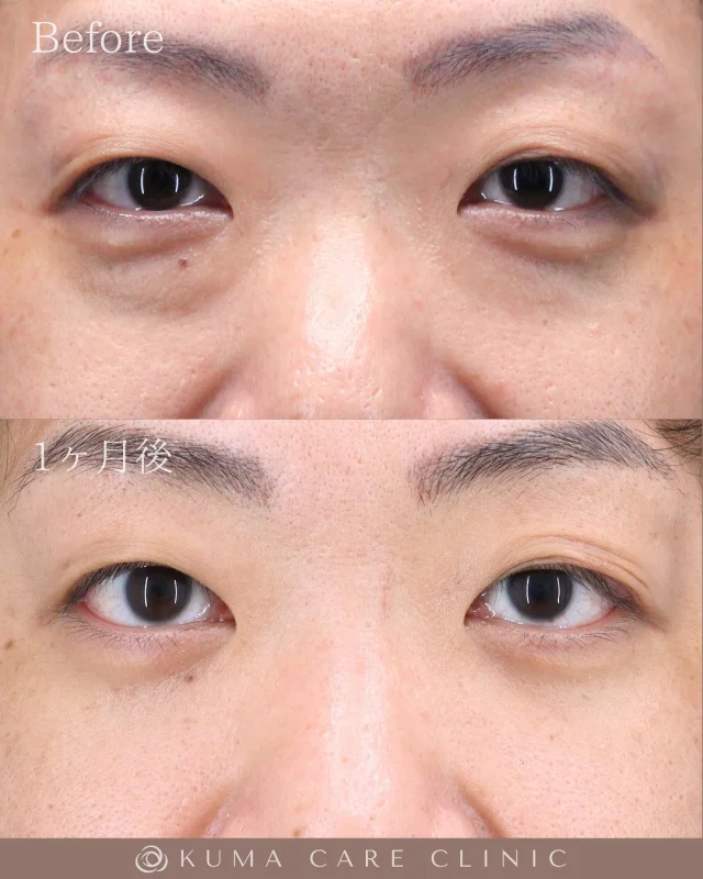 🌱
🌱30代後半の男性のくまとり解説🌱 

術前・術直後・一ヶ月後のノーメイクでの比較写真です。 
⚠️実際の脂肪を載せているため、苦手な方はご注意下さい。 

こんにちは。 
クマケアクリニック名古屋院 
院長宮西重史です。 

今回は30代後半の男性のクマ取りをさせていただきました。 
この方は膨らみによる影ぐま（黒ぐま）があり、
今回脱脂術を行わせていただきました。
脱脂のみでスッキリと綺麗なお目元になったと思います。 

数年前から膨らみが気になっていた患者様で、
紹介をきっかけに当院にご来院いただきました。 
仕上がりに関してもご満足いただけたようで、大変光栄です。 

ご本人様からも「膨らみがとれてスッキリして満足です」とのコメントをいただきました。 

この度はクマケアクリニック名古屋院を選んでいただき
誠にありがとうございました。

_________________________

■施術名 下眼瞼経結膜脱脂術
■価格　 250,000円（税抜価格 227,273円）
■リスク
◉内出血・むくみ
　出来る限り丁寧に処置していますが、
　術後1〜2週間程度は生じる可能性があります。
◉術後出血
　治癒過程により、術後1週間以内は
　血液混じりの涙が出る可能性があります。
◉結膜浮腫・結膜出血
　かなり稀ですが生じる可能性があります。
　一般的には術後1～2週間で軽快します。

_________________________

KUMA CARE CLINIC 名古屋院
📍名古屋市西区名駅3-10-15 名駅三丁目ビル2階
☎️052-564-7070
⏰9:00〜18:00
_________________________

#KUMACARECLINIC名古屋 #クマケアクリニック名古屋
#クマ治療 #クマケア #クマ取り #脱脂術
#クマ取り脱脂術 #目の下のたるみ取り
#目の下のクマ取り #目の下のクマたるみ取り
#目の下の若返り #アンチエイジング
#くま #クマ #下眼瞼脱脂術 #たるみ
#愛知 #名古屋 #名駅 #クマ治療名古屋
#美容外科 #美容外科名古屋 #クマ取り専門　
#美容整形 #美容クリニック