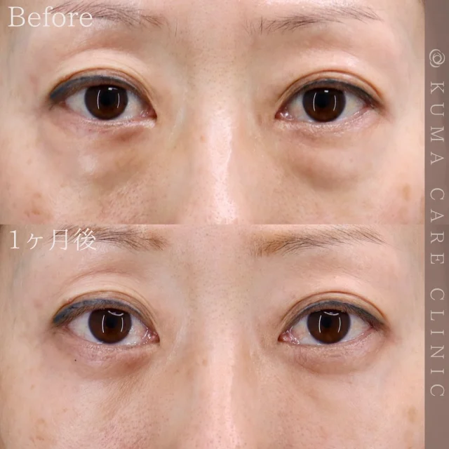 🌿

40代後半　女性の症例写真です📷
術前・術直後・一ヶ月後のノーメイクでの比較写真です。
⚠️実際の脂肪を載せているため、苦手な方はご注意下さい。

「ダウンタイムがどうなるのか心配でしたが、むくみは3〜5日ほどで収まり、メイクをすれば気にならない程度でした。年齢的に事前に聞いていた通りシワが少し気にはなりますが、クマがなくなって気持ちも上がり手術をして本当に良かったです。周りからも目元が優しい印象になったと言われました。」と嬉しいお声を頂戴しました✨

カウンセリング・手術のご予約は、Web予約またはお電話にて承っております。カウンセリングは無料となります🌱
手術をご検討中の方は、是非ご相談にお越しくださいませ。
皆様のご来院をスタッフ一同、心よりお待ちしております🕊️

_________________________

■施術名  下眼瞼経結膜脱脂術
■価格  250,000円（税抜価格227,273円）　
■リスク
◉内出血・むくみ
　出来る限り丁寧に処置していますが、
　術後1〜2週間程度は生じる可能性があります。
◉術後出血
　治癒過程により、術後1週間以内は
　血液混じりの涙が出る可能性があります。
◉結膜浮腫・結膜出血
　かなり稀ですが生じる可能性があります。
　一般的には術後1～2週間で軽快します。

_________________________

KUMA CARE CLINIC 大阪院
📍大阪市北区鶴野町2-1タナダビル5F
☎️06-6136-3537
⏰10:00〜19:00

#KUMACARECLINIC #クマケアクリニック
#クマ治療 #クマケア #クマ取り #脱脂術
#クマ取り脱脂術 #目の下のたるみ取り
#目の下のクマ取り #目の下のクマたるみ取り
#目の下の若返り #アンチエイジング
#くま #クマ #下眼瞼脱脂術 #たるみ
#大阪 #梅田 #茶屋町 #クマ治療大阪
#美容外科 #美容外科大阪 #クマ取り専門
#美容整形 #美容クリニック
