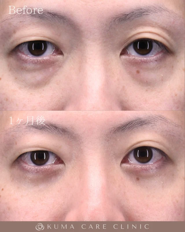 🌱
🌱30代後半の男性のくまとり解説🌱 

術前・術直後・一ヶ月後のノーメイクでの比較写真です。 
⚠️実際の脂肪を載せているため、苦手な方はご注意下さい。 

こんにちは。 
クマケアクリニック名古屋院 
院長宮西重史です。 

今回は30代後半の男性のクマ取りをさせていただきました。 
この方は膨らみによる影ぐまがありましたが、
今回脱脂術を行わせていただきました。
涙袋がハッキリとし、綺麗なお目元になりました。 

数年前から膨らみが気になっていた患者様で、
インターネット検索にて当院を見つけていただきだき、ご来院いただきました。 
仕上がりに関してもご満足いただけたようで、大変光栄です。 

ご本人様からも「気になっていた目の下の膨らみが消えて満足しています」とのコメントをいただきました。 

この度はクマケアクリニック名古屋院を選んでいただき
誠にありがとうございました。

_________________________

■施術名 下眼瞼経結膜脱脂術
■価格　 250,000円（税抜価格 227,273円）
■リスク
◉内出血・むくみ
　出来る限り丁寧に処置していますが、
　術後1〜2週間程度は生じる可能性があります。
◉術後出血
　治癒過程により、術後1週間以内は
　血液混じりの涙が出る可能性があります。
◉結膜浮腫・結膜出血
　かなり稀ですが生じる可能性があります。
　一般的には術後1～2週間で軽快します。

_________________________

KUMA CARE CLINIC 名古屋院
📍名古屋市西区名駅3-10-15 名駅三丁目ビル2階
☎️052-564-7070
⏰9:00〜18:00
_________________________

#KUMACARECLINIC名古屋 #クマケアクリニック名古屋
#クマ治療 #クマケア #クマ取り #脱脂術
#クマ取り脱脂術 #目の下のたるみ取り
#目の下のクマ取り #目の下のクマたるみ取り
#目の下の若返り #アンチエイジング
#くま #クマ #下眼瞼脱脂術 #たるみ
#愛知 #名古屋 #名駅 #クマ治療名古屋
#美容外科 #美容外科名古屋 #クマ取り専門　
#美容整形 #美容クリニック
