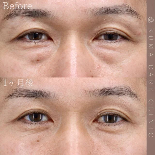 🌿

50代後半　男性の症例写真です📷
術前・術直後・一ヶ月後のノーメイクでの比較写真です。
⚠️実際の脂肪を載せているため、苦手な方はご注意下さい。

「術後2日ほどは内出血があり、術後6日目までは何回か右目から血混じりの涙が出ることがあったが、そのほかは目立った症状なく落ち着きました。仕上がり満足です。」と嬉しいお声を頂戴しました✨

カウンセリング・手術のご予約は、Web予約またはお電話にて承っております。カウンセリングは無料となります🌱
手術をご検討中の方は、是非ご相談にお越しくださいませ。
皆様のご来院をスタッフ一同、心よりお待ちしております🕊️

_________________________

■施術名  下眼瞼経結膜脱脂術
■価格  250,000円（税抜価格227,273円）　
■リスク
◉内出血・むくみ
　出来る限り丁寧に処置していますが、
　術後1〜2週間程度は生じる可能性があります。
◉術後出血
　治癒過程により、術後1週間以内は
　血液混じりの涙が出る可能性があります。
◉結膜浮腫・結膜出血
　かなり稀ですが生じる可能性があります。
　一般的には術後1～2週間で軽快します。

_________________________

KUMA CARE CLINIC 大阪院
📍大阪市北区鶴野町2-1タナダビル5F
☎️06-6136-3537
⏰10:00〜19:00

#KUMACARECLINIC #クマケアクリニック
#クマ治療 #クマケア #クマ取り #脱脂術
#クマ取り脱脂術 #目の下のたるみ取り
#目の下のクマ取り #目の下のクマたるみ取り
#目の下の若返り #アンチエイジング
#くま #クマ #下眼瞼脱脂術 #たるみ
#大阪 #梅田 #茶屋町 #クマ治療大阪
#美容外科 #美容外科大阪 #クマ取り専門
#美容整形 #美容クリニック