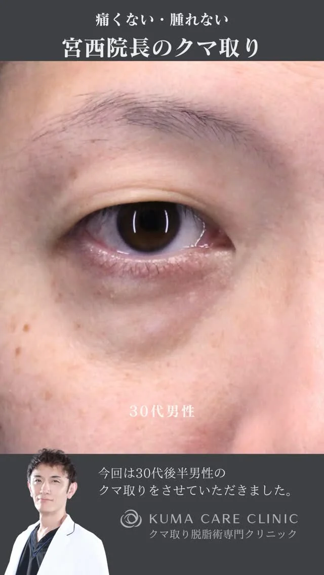 🌱
🌱30代後半の男性のくまとり解説🌱 

こんにちは。 
クマケアクリニック名古屋院 
院長宮西重史です。 

今回は30代後半の男性のクマ取りをさせていただきました。 
この方は膨らみによる影ぐまがありましたが、
今回脱脂術を行わせていただきました。
涙袋がハッキリとし、綺麗なお目元になりました。 

数年前から膨らみが気になっていた患者様で、
インターネット検索にて当院を見つけていただきだき、ご来院いただきました。 
仕上がりに関してもご満足いただけたようで、大変光栄です。 

ご本人様からも「気になっていた目の下の膨らみが消えて満足しています」とのコメントをいただきました。 

この度はクマケアクリニック名古屋院を選んでいただき
誠にありがとうございました。

_________________________

■施術名 下眼瞼経結膜脱脂術
■価格　 250,000円（税抜価格 227,273円）
■リスク
◉内出血・むくみ
　出来る限り丁寧に処置していますが、
　術後1〜2週間程度は生じる可能性があります。
◉術後出血
　治癒過程により、術後1週間以内は
　血液混じりの涙が出る可能性があります。
◉結膜浮腫・結膜出血
　かなり稀ですが生じる可能性があります。
　一般的には術後1～2週間で軽快します。

_________________________

KUMA CARE CLINIC 名古屋院
📍名古屋市西区名駅3-10-15 名駅三丁目ビル2階
☎️052-564-7070
⏰9:00〜18:00
_________________________

#KUMACARECLINIC名古屋 #クマケアクリニック名古屋
#クマ治療 #クマケア #クマ取り #脱脂術
#クマ取り脱脂術 #目の下のたるみ取り
#目の下のクマ取り #目の下のクマたるみ取り
#目の下の若返り #アンチエイジング
#くま #クマ #下眼瞼脱脂術 #たるみ
#愛知 #名古屋 #名駅 #クマ治療名古屋
#美容外科 #美容外科名古屋 #クマ取り専門　
#美容整形 #美容クリニック