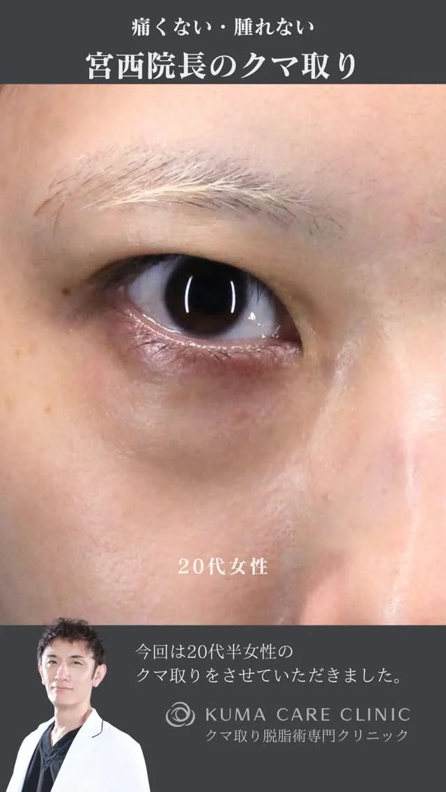 🌱
🌱20代後半の女性のくまとり解説🌱 

こんにちは。 
クマケアクリニック名古屋院 
院長宮西重史です。 

今回は20代後半の女性のクマ取りをさせていただきました。 
この方は膨らみによる影ぐま（黒ぐま）がありました。 
今回脱脂のみで膨らみによる影が減り綺麗になられた患者様だと思います。 
頬の痩せ感にはヒアルロン酸注入を行なってもより良くなると思います。 

数年前から黒ぐまが気になっていたと仰られた痛み患者様でした。
術後はスッキリとした綺麗な目元になり仕上がりに関してもご満足いただけたようで、大変光栄です。 

ご本人様からも「全然痛みもなくてどんどん顔がスッキリとしてきてクマを取るだけでこんなに変わるんだとびっくりしたした。周りからも「めっちゃ綺麗！」と言ってもらえて嬉しいです。クマ取りして良かったと思ってます」とのコメントをいただきました。 

この度はクマケアクリニック名古屋院を選んでいただき
誠にありがとうございました。

_________________________

■施術名 下眼瞼経結膜脱脂術
■価格　 250,000円（税抜価格 227,273円）
■リスク
◉内出血・むくみ
　出来る限り丁寧に処置していますが、
　術後1〜2週間程度は生じる可能性があります。
◉術後出血
　治癒過程により、術後1週間以内は
　血液混じりの涙が出る可能性があります。
◉結膜浮腫・結膜出血
　かなり稀ですが生じる可能性があります。
　一般的には術後1～2週間で軽快します。

_________________________

KUMA CARE CLINIC 名古屋院
📍名古屋市西区名駅3-10-15 名駅三丁目ビル2階
☎️052-564-7070
⏰9:00〜18:00
_________________________

#KUMACARECLINIC名古屋 #クマケアクリニック名古屋
#クマ治療 #クマケア #クマ取り #脱脂術
#クマ取り脱脂術 #目の下のたるみ取り
#目の下のクマ取り #目の下のクマたるみ取り
#目の下の若返り #アンチエイジング
#くま #クマ #下眼瞼脱脂術 #たるみ
#愛知 #名古屋 #名駅 #クマ治療名古屋
#美容外科 #美容外科名古屋 #クマ取り専門　
#美容整形 #美容クリニック