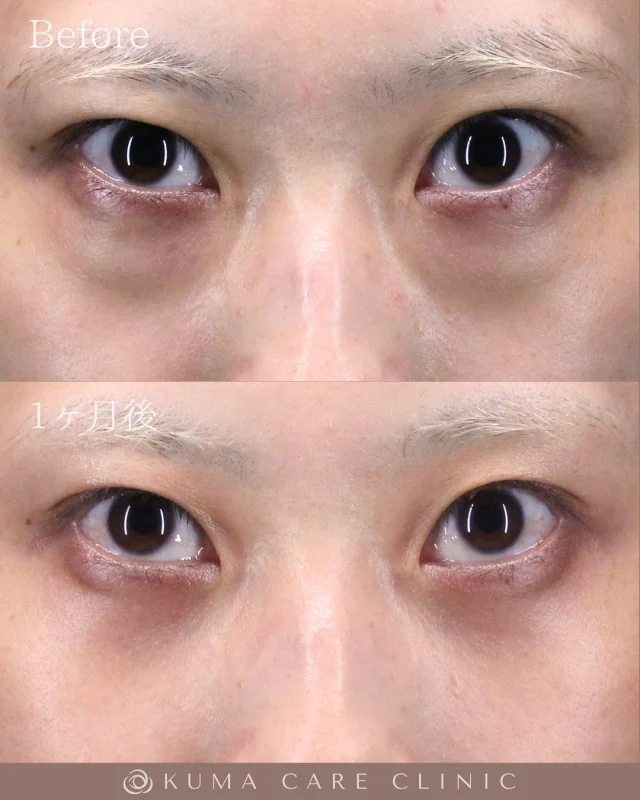 🌱
🌱20代後半の女性のくまとり解説🌱 

術前・術直後・一ヶ月後のノーメイクでの比較写真です。 
⚠️実際の脂肪を載せているため、苦手な方はご注意下さい。 

こんにちは。 
クマケアクリニック名古屋院 
院長宮西重史です。 

今回は20代後半の女性のクマ取りをさせていただきました。 
この方は膨らみによる影ぐま（黒ぐま）がありました。 
今回脱脂のみで膨らみによる影が減り綺麗になられた患者様だと思います。 
頬の痩せ感にはヒアルロン酸注入を行なってもより良くなると思います。 

数年前から黒ぐまが気になっていたと仰られた痛み患者様でした。
術後はスッキリとした綺麗な目元になり仕上がりに関してもご満足いただけたようで、大変光栄です。 

ご本人様からも「全然痛みもなくてどんどん顔がスッキリとしてきてクマを取るだけでこんなに変わるんだとびっくりしたした。周りからも「めっちゃ綺麗！」と言ってもらえて嬉しいです。クマ取りして良かったと思ってます」とのコメントをいただきました。 

この度はクマケアクリニック名古屋院を選んでいただき
誠にありがとうございました。

_________________________

■施術名 下眼瞼経結膜脱脂術
■価格　 250,000円（税抜価格 227,273円）
■リスク
◉内出血・むくみ
　出来る限り丁寧に処置していますが、
　術後1〜2週間程度は生じる可能性があります。
◉術後出血
　治癒過程により、術後1週間以内は
　血液混じりの涙が出る可能性があります。
◉結膜浮腫・結膜出血
　かなり稀ですが生じる可能性があります。
　一般的には術後1～2週間で軽快します。

_________________________

KUMA CARE CLINIC 名古屋院
📍名古屋市西区名駅3-10-15 名駅三丁目ビル2階
☎️052-564-7070
⏰9:00〜18:00
_________________________

#KUMACARECLINIC名古屋 #クマケアクリニック名古屋
#クマ治療 #クマケア #クマ取り #脱脂術
#クマ取り脱脂術 #目の下のたるみ取り
#目の下のクマ取り #目の下のクマたるみ取り
#目の下の若返り #アンチエイジング
#くま #クマ #下眼瞼脱脂術 #たるみ
#愛知 #名古屋 #名駅 #クマ治療名古屋
#美容外科 #美容外科名古屋 #クマ取り専門　
#美容整形 #美容クリニック