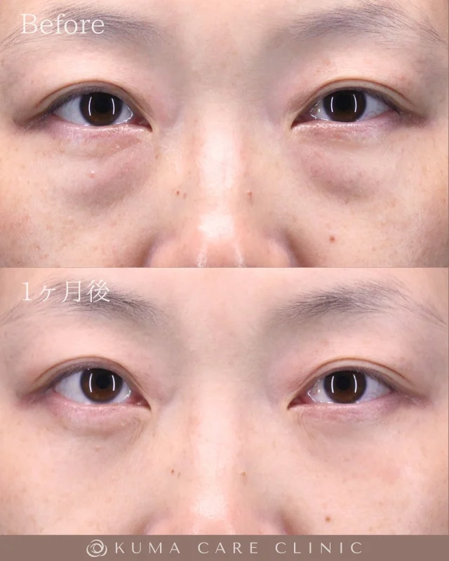 🌱
🌱30代後半の女性のくまとり解説🌱 

術前・術直後・一ヶ月後のノーメイクでの比較写真です。 
⚠️実際の脂肪を載せているため、苦手な方はご注意下さい。 

こんにちは。 
クマケアクリニック名古屋院 
院長宮西重史です。 

今回は30代後半の女性のクマ取りをさせていただきました。 
この方は膨らみによる影ぐま（黒ぐま）がありましたが、
今回脱脂術を行わせていただき、涙袋がハッキリとし、綺麗なお目元になりました。 

以前より膨らみが気になっていたと仰られていた患者様でした。 
仕上がりに関してもご満足いただけたようで、大変光栄です。 

ご本人様からも「術中から痛みはほとんどなく、すぐおわりました。少しの腫れと違和感だけで、薬もほとんど飲まずで大丈夫でした。やってよかったです。」とのコメントをいただきました。 

この度はクマケアクリニック名古屋院を選んでいただき
誠にありがとうございました。

_________________________

■施術名 下眼瞼経結膜脱脂術
■価格　 250,000円（税抜価格 227,273円）
■リスク
◉内出血・むくみ
　出来る限り丁寧に処置していますが、
　術後1〜2週間程度は生じる可能性があります。
◉術後出血
　治癒過程により、術後1週間以内は
　血液混じりの涙が出る可能性があります。
◉結膜浮腫・結膜出血
　かなり稀ですが生じる可能性があります。
　一般的には術後1～2週間で軽快します。

_________________________

KUMA CARE CLINIC 名古屋院
📍名古屋市西区名駅3-10-15 名駅三丁目ビル2階
☎️052-564-7070
⏰9:00〜18:00
_________________________

#KUMACARECLINIC名古屋 #クマケアクリニック名古屋
#クマ治療 #クマケア #クマ取り #脱脂術
#クマ取り脱脂術#くま #クマ #下眼瞼脱脂術 #たるみ
#愛知 #名古屋 #名駅 #クマ治療名古屋
#美容外科 #美容外科名古屋 #クマ取り専門　
#美容整形 #美容クリニック