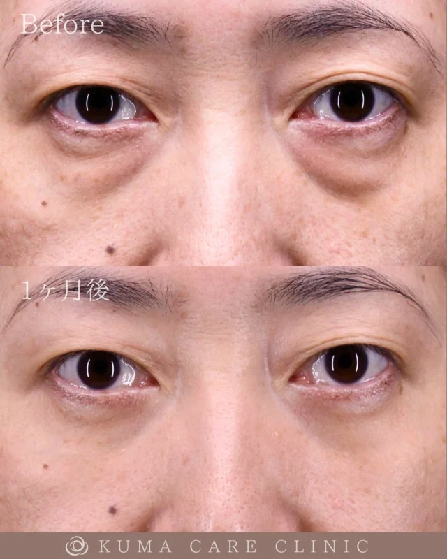 🌱50代前半の女性のクマ取り解説🌱

術前・術直後・一ヶ月後のノーメイクでの比較写真です。
⚠️実際の脂肪を載せているため、苦手な方はご注意下さい。

こんにちは。
クマケアクリニック名古屋院、院長宮西重史です。

今回は50代前半の女性のくまとりをさせていただきました。
この方は膨らみによるクマがある患者様でした。

初めての美容クリニックでの処置という事で大変緊張されていたご様子でしたので、緊張がほぐれるようにスタッフ一同で対応させていただきました。

仕上がりに関しては大変綺麗に仕上がったと思います。
ご本人様にも満足いただけて、大変光栄です。
チーク部分の痩せが少しあるので、ヒアルロン酸注入をするとさらにキレイになると思います。

ご本人様からも「気になっていた膨らみがなくなり、すごくスッキリしてやってよかった。鏡を見るたびに満足です」とコメントをいただきました

この度はクマケアクリニック名古屋院を選んでいただき誠にありがとうございました。

_________________________

■施術名  下眼瞼経結膜脱脂術
■価格　  250,000円（税抜価格 227,273円）
■リスク
◉内出血・むくみ
　出来る限り丁寧に処置していますが、
　術後1〜2週間程度は生じる可能性があります。
◉術後出血
　治癒過程により、術後1週間以内は
　血液混じりの涙が出る可能性があります。
◉結膜浮腫・結膜出血
　かなり稀ですが生じる可能性があります。
　一般的には術後1～2週間で軽快します。

_________________________

KUMA CARE CLINIC 名古屋院
📍名古屋市西区名駅3-10-15 名駅三丁目ビル2階
☎️052-564-7070
⏰9:00〜18:00
_________________________

#KUMACARECLINIC名古屋 #クマケアクリニック名古屋
#クマ治療 #クマケア #クマ取り #脱脂術
#クマ取り脱脂術 #目の下のたるみ取り
#目の下のクマ取り #目の下のクマたるみ取り
#目の下の若返り #アンチエイジング
#くま #クマ #下眼瞼脱脂術 #たるみ
#愛知 #名古屋 #名駅 #クマ治療名古屋
#美容外科 #美容外科名古屋 #クマ取り専門　
#美容整形 #美容クリニック