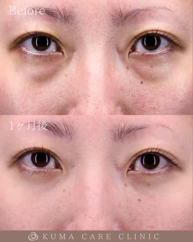 🌱30代前半の女性のクマ取り解説🌱

術前・術直後・一ヶ月後のノーメイクでの比較写真です。
⚠️実際の脂肪を載せているため、苦手な方はご注意下さい。

こんにちは。
クマケアクリニック名古屋院
院長宮西重史です。

今回は30代前半の女性のクマ取りをさせていただきました。
この方は膨らみによるクマがありましたが、今回脱脂のみで綺麗になられた患者様だと思います。

美容クリニックを予約したのも初めての方でしたので、なるべく緊張感がほぐれるように、そして不安なく手術に臨めるようスタッフ一同で対応させていただきました。

20代から膨らみが気になっていたと仰られておりましたが、仕上がりに関してもご本人様にも満足いただけたようで、大変光栄です。

ご本人様からも「手術中の痛みはほとんど無くビックリしました。初めてだったので緊張しましたが先生やスタッフさんが優しくて安心しました。仕上がりもキレイで本当にクマだけが無くなった状態になりやってよかったです。ありがとうございました。」とコメントをいただきました。

この度はクマケアクリニック名古屋院を選んでいただき誠にありがとうございました。

_________________________

■施術名  下眼瞼経結膜脱脂術
■価格　  250,000円（税抜価格 227,273円）
■リスク
◉内出血・むくみ
　出来る限り丁寧に処置していますが、
　術後1〜2週間程度は生じる可能性があります。
◉術後出血
　治癒過程により、術後1週間以内は
　血液混じりの涙が出る可能性があります。
◉結膜浮腫・結膜出血
　かなり稀ですが生じる可能性があります。
　一般的には術後1～2週間で軽快します。

_________________________

KUMA CARE CLINIC 名古屋院
📍名古屋市西区名駅3-10-15 名駅三丁目ビル2階
☎️052-564-7070
⏰9:00〜18:00
_________________________

#KUMACARECLINIC名古屋 #クマケアクリニック名古屋
#クマ治療 #クマケア #クマ取り #脱脂術
#クマ取り脱脂術 #目の下のたるみ取り
#目の下のクマ取り #目の下のクマたるみ取り
#目の下の若返り #アンチエイジング
#くま #クマ #下眼瞼脱脂術 #たるみ
#愛知 #名古屋 #名駅 #クマ治療名古屋
#美容外科 #美容外科名古屋 #クマ取り専門　
#美容整形 #美容クリニック