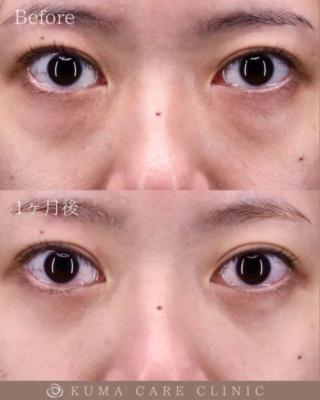 🌱30代前半の女性のクマ取り解説🌱

術前・術直後・一ヶ月後のノーメイクでの比較写真です。
⚠️実際の脂肪を載せているため、苦手な方はご注意下さい。

こんにちは。
クマケアクリニック名古屋院
院長宮西重史です。

今回は30代前半の女性のクマ取りをさせていただきました。
この方は膨らみによるクマがありましたが、今回脱脂のみで綺麗になられた患者様だと思います。

最近になって特に膨らみが大きくなってきた気がすると仰っておられました。術後はスッキリしたお目元になり、仕上がりに関してもご満足いただけたようで、大変光栄です。

ご本人様からも「目の下のたるみがスッキリして良かったです」とコメントをいただきました。

この度はクマケアクリニック名古屋院を選んでいただき誠にありがとうございました。

_________________________

■施術名  下眼瞼経結膜脱脂術
■価格　  250,000円（税抜価格 227,273円）
■リスク
◉内出血・むくみ
　出来る限り丁寧に処置していますが、
　術後1〜2週間程度は生じる可能性があります。
◉術後出血
　治癒過程により、術後1週間以内は
　血液混じりの涙が出る可能性があります。
◉結膜浮腫・結膜出血
　かなり稀ですが生じる可能性があります。
　一般的には術後1～2週間で軽快します。

_________________________

KUMA CARE CLINIC 名古屋院
📍名古屋市西区名駅3-10-15 名駅三丁目ビル2階
☎️052-564-7070
⏰9:00〜18:00
_________________________

#KUMACARECLINIC名古屋 #クマケアクリニック名古屋
#クマ治療 #クマケア #クマ取り #脱脂術
#クマ取り脱脂術 #目の下のたるみ取り
#目の下のクマ取り #目の下のクマたるみ取り
#目の下の若返り #アンチエイジング
#くま #クマ #下眼瞼脱脂術 #たるみ
#愛知 #名古屋 #名駅 #クマ治療名古屋
#美容外科 #美容外科名古屋 #クマ取り専門　
#美容整形 #美容クリニック