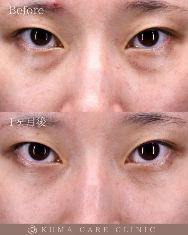 🌱20代後半女性のクマ取り解説🌱

術前・術直後・一ヶ月後のノーメイクでの比較写真です。
⚠️実際の脂肪を載せているため、苦手な方はご注意下さい。

こんにちは。
クマケアクリニック名古屋院
院長宮西重史です。

今回は20代後半の女性のクマ取りをさせていただきました。
この方は膨らみによるクマがありましたが、20代ということもあり、今回脱脂のみで綺麗になられた患者様だと思います。

他のクリニックでクマを指摘されてから気になり始め、もっと可愛くなりたいと、当院を選んでくださいました。術後はスッキリ、可愛らしい目元になったと思います。仕上がりに関してもご満足いただけたようで、大変光栄です。

ご本人様からも「黒ぐまが綺麗に無くなって、とても満足しています。思ってたより涙袋は出なかったのですが、本来の目的であるクマ取りは出来たので良かったです。カウンセリングもとても丁寧で安心できました。ありがとうございました。」とのコメントをいただきました。

この度はクマケアクリニック名古屋院を選んでいただき誠にありがとうございました。

_________________________

■施術名  下眼瞼経結膜脱脂術
■価格　  250,000円（税抜価格 227,273円）
■リスク
◉内出血・むくみ
　出来る限り丁寧に処置していますが、
　術後1〜2週間程度は生じる可能性があります。
◉術後出血
　治癒過程により、術後1週間以内は
　血液混じりの涙が出る可能性があります。
◉結膜浮腫・結膜出血
　かなり稀ですが生じる可能性があります。
　一般的には術後1～2週間で軽快します。

_________________________

KUMA CARE CLINIC 名古屋院
📍名古屋市西区名駅3-10-15 名駅三丁目ビル2階
☎️052-564-7070
⏰9:00〜18:00
_________________________

#KUMACARECLINIC名古屋 #クマケアクリニック名古屋
#クマ治療 #クマケア #クマ取り #脱脂術
#クマ取り脱脂術 #目の下のたるみ取り
#目の下のクマ取り #目の下のクマたるみ取り
#目の下の若返り #アンチエイジング
#くま #クマ #下眼瞼脱脂術 #たるみ
#愛知 #名古屋 #名駅 #クマ治療名古屋
#美容外科 #美容外科名古屋 #クマ取り専門　
#美容整形 #美容クリニック