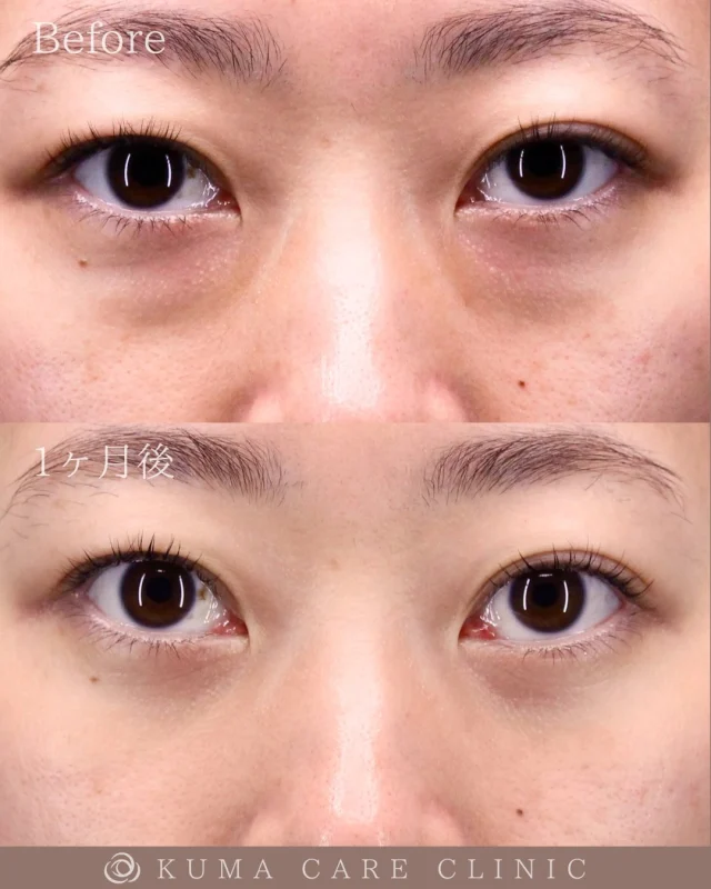 🌱30代後半の女性のクマ取り解説🌱

術前・術直後・一ヶ月後のノーメイクでの比較写真です。
⚠️実際の脂肪を載せているため、苦手な方はご注意下さい。

こんにちは。
クマケアクリニック名古屋院
院長宮西重史です。

今回は30代後半の女性のクマ取りをさせていただきました。
この方は膨らみによるクマがあり、今回脱脂術を行わせていただきました。脱脂のみでスッキリと綺麗なお目元になったと思います。

10年前から膨らみが気になっていた患者様で、紹介をきっかけに当院にご来院いただきました。
仕上がりに関してもご満足いただけたようで、大変光栄です。

ご本人様からも「結果から言いますと大満足でした。とにかく見た目がスッキリして若返った感じです。術後不安な時はアフターフォローが充実していて電話対応もすごく丁寧で安心しました。ありがとうございました。」とのコメントをいただきました。

この度はクマケアクリニック名古屋院を選んでいただき誠にありがとうございました。

_________________________

宮西院長のクマ取り脱脂術は
・名古屋院
・東京銀座院
でお受けいただけます。

カウンセリング・手術のご予約は、Web予約またはお電話にて承っております。
カウンセリングは無料となります🌱

ご自宅からできるオンライン無料相談も実施しておりますので、手術をご検討中の方は、是非ご相談くださいませ。
皆様のご来院をスタッフ一同、心よりお待ちしております🕊️
_________________________

■施術名  下眼瞼経結膜脱脂術
■価格 ¥22,0000（税込¥242,000）
■リスク
◉内出血・むくみ
　出来る限り丁寧に処置していますが、
　術後1〜2週間程度は生じる可能性があります。
◉術後出血
　治癒過程により、術後1週間以内は
　血液混じりの涙が出る可能性があります。
◉結膜浮腫・結膜出血
　かなり稀ですが生じる可能性があります。
　一般的には術後1～2週間で軽快します。
_________________________

KUMA CARE CLINIC 名古屋院
📍名古屋市西区名駅3-10-15 名駅三丁目ビル2階
☎️052-564-7070
⏰9:00〜18:00

KUMA CARE CLINIC 東京銀座院
📍東京都中央区銀座1-28-16 SUGIURA GINZA 7階
☎️03-6263-2509
⏰10:00〜19:00
_________________________

【症例実績】
2024年3月 開院
開院から累計：3,000件

◼️ 直近実績
2026年
・1月　136件

◼️ 年別実績
2025年　1,516件
2024年　1,348件

#KUMACARECLINIC #クマケアクリニック
#クマ取り #クマケア #脱脂