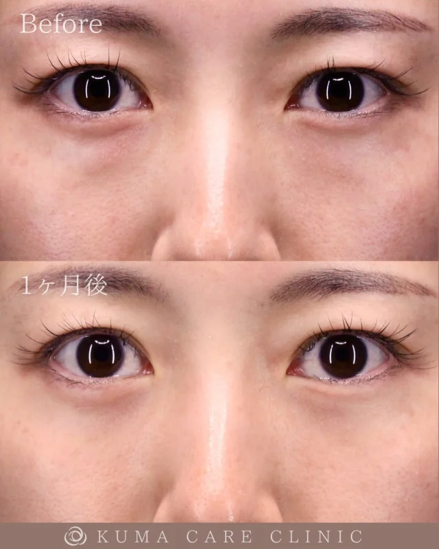 🌱20代後半の女性のクマ取り解説🌱

術前・術直後・一ヶ月後のノーメイクでの比較写真です。
⚠️実際の脂肪を載せているため、苦手な方はご注意下さい。

こんにちは。
クマケアクリニック名古屋院
院長宮西重史です。

今回は20代後半の女性のクマ取りをさせていただきました。
この方は膨らみによるクマがありましたが、今回脱脂のみで膨らみが無くなり綺麗になられた患者様だと思います。

数年前からクマが気になっていたと仰られていた患者様でした。術後はスッキリとした綺麗な目元になり仕上がりに関してもご満足いただけたようで、大変光栄です。

ご本人様からも「朝夕に鏡を見た時にクマが無いことに感動しました！術中も痛みが無かったので本当にやって良かったと思いました！」とのコメントをいただきました。

この度はクマケアクリニック名古屋院を選んでいただき誠にありがとうございました。
_________________________

宮西院長のクマ取り脱脂術は
・名古屋院
・東京銀座院
でお受けいただけます。

カウンセリング・手術のご予約は、Web予約またはお電話にて承っております。
カウンセリングは無料となります🌱

ご自宅からできるオンライン無料相談も実施しておりますので、手術をご検討中の方は、是非ご相談くださいませ。
皆様のご来院をスタッフ一同、心よりお待ちしております🕊️
_________________________

■施術名  下眼瞼経結膜脱脂術
■価格　¥22,0000（税込¥242,000）
■リスク
◉内出血・むくみ
　出来る限り丁寧に処置していますが、
　術後1〜2週間程度は生じる可能性があります。
◉術後出血
　治癒過程により、術後1週間以内は
　血液混じりの涙が出る可能性があります。
◉結膜浮腫・結膜出血
　かなり稀ですが生じる可能性があります。
　一般的には術後1～2週間で軽快します。
_________________________

KUMA CARE CLINIC 名古屋院
📍名古屋市西区名駅3-10-15 名駅三丁目ビル2階
☎️052-564-7070
⏰9:00〜18:00

KUMA CARE CLINIC 東京銀座院
📍東京都中央区銀座1-28-16 SUGIURA GINZA 7階
☎️03-6263-2509
⏰10:00〜19:00
_________________________

【症例実績】
2024年3月 開院
開院から累計：3,000件

◼️ 直近実績
2026年
・1月　136件

◼️ 年別実績
2025年　1,516件
2024年　1,348件

#KUMACARECLINIC #クマケアクリニック
#クマ取り #クマケア #脱脂