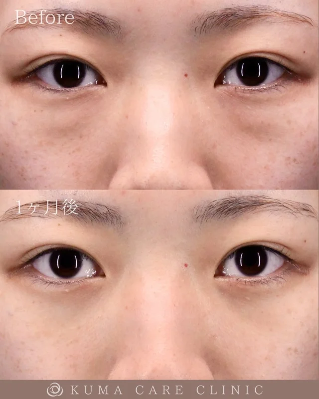🌱20代半ばの女性のクマ取り解説🌱

術前・術直後・一ヶ月後のノーメイクでの比較写真です。
⚠️実際の脂肪を載せているため、苦手な方はご注意下さい。

こんにちは。
クマケアクリニック名古屋院
院長宮西重史です。

今回は20代半ばの女性のクマ取りをさせていただきました。
この方は膨らみによるクマがありましたが、今回脱脂のみで膨らみが無くなり綺麗になられた患者様だと思います。

以前からクマが気になっていたと仰られていた患者様でした。術後はスッキリとした綺麗な目元になり仕上がりに関してもご満足いただけたようで、大変光栄です。

ご本人様からも「いつも鏡を見るたびに気になっていたクマがなくなって毎日メイクが楽しくなりました。クマ取りする前は怖かったけど、実際やってみて痛みも全然なく浮腫も本当に少しだけで次の日から仕事にいけるレベルでした。もっと早くやればよかったと思いました！」とのコメントをいただきました。

この度はクマケアクリニック名古屋院を選んでいただき誠にありがとうございました。

_________________________

宮西院長のクマ取り脱脂術は
・名古屋院
・東京銀座院
でお受けいただけます。

カウンセリング・手術のご予約は、Web予約またはお電話にて承っております。
カウンセリングは無料となります🌱

ご自宅からできるオンライン無料相談も実施しておりますので、手術をご検討中の方は、是非ご相談くださいませ。
皆様のご来院をスタッフ一同、心よりお待ちしております🕊️
_________________________

■施術名  下眼瞼経結膜脱脂術
■価格 ¥22,0000（税込¥242,000）
■リスク
◉内出血・むくみ
　出来る限り丁寧に処置していますが、
　術後1〜2週間程度は生じる可能性があります。
◉術後出血
　治癒過程により、術後1週間以内は
　血液混じりの涙が出る可能性があります。
◉結膜浮腫・結膜出血
　かなり稀ですが生じる可能性があります。
　一般的には術後1～2週間で軽快します。
_________________________

KUMA CARE CLINIC 名古屋院
📍名古屋市西区名駅3-10-15 名駅三丁目ビル2階
☎️052-564-7070
⏰9:00〜18:00

KUMA CARE CLINIC 東京銀座院
📍東京都中央区銀座1-28-16 SUGIURA GINZA 7階
☎️03-6263-2509
⏰10:00〜19:00
_________________________

【症例実績】
2024年3月 開院
開院から累計：3,000件

◼️ 直近実績
2026年
・1月　136件

◼️ 年別実績
2025年　1,516件
2024年　1,348件

#KUMACARECLINIC #クマケアクリニック
#クマ取り #クマケア #脱脂